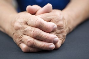 http://www.dreamstime.com/stock-images-rheumatoid-arthritis-hands-woman-deformed-blue-background-image41407224