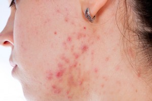 acne SM shutterstock_122483422