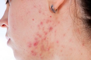 acne shutterstock_122483422