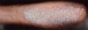 psoriasis