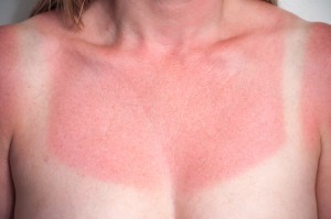 sunburn shutterstock_159200453