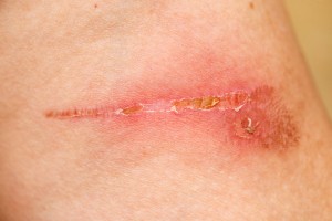 wound healing shutterstock_16554190